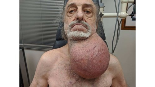 soccer ball sized tumor