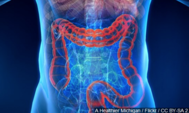 Colon Cancer