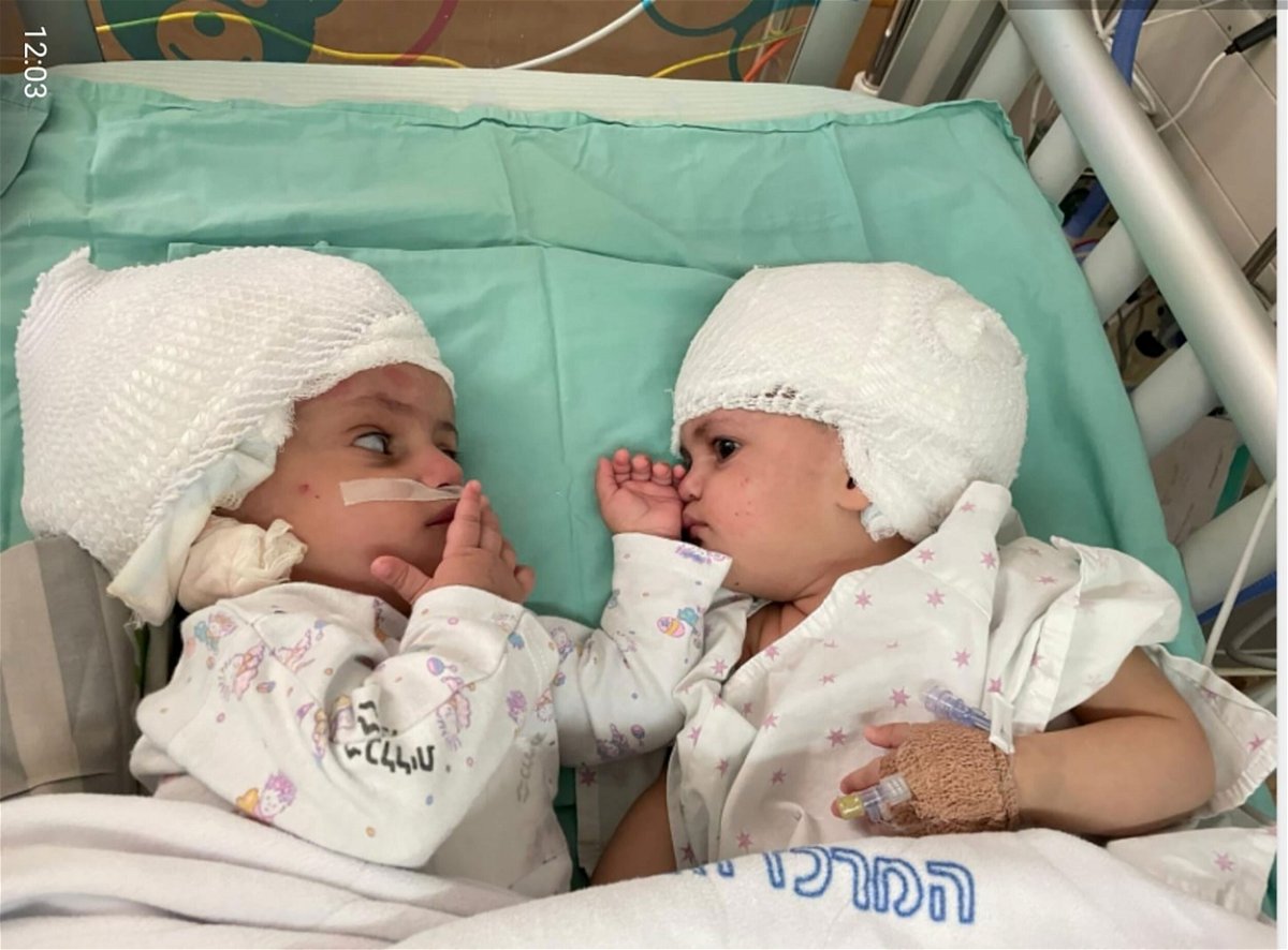 <i>Sorokaa Medical Centre/Reuters</i><br/>The twins can now face each other