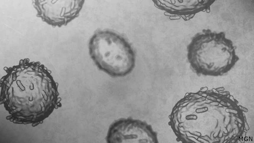 Texas resident with monkeypox dies, marking first death in the U.S ...