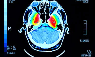 A lab test that can tell doctors if someone has Parkinson's disease is a long-sought goal of researchers.