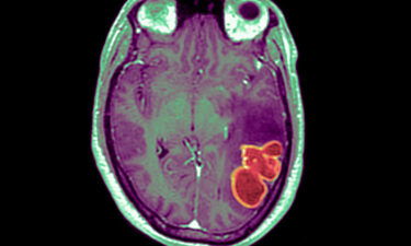 The CDC is investigating a cluster of rare and serious brain abscesses in kids in and around Las Vegas.