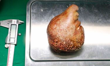 The world's largest kidney stone on display in Sri Lanka.